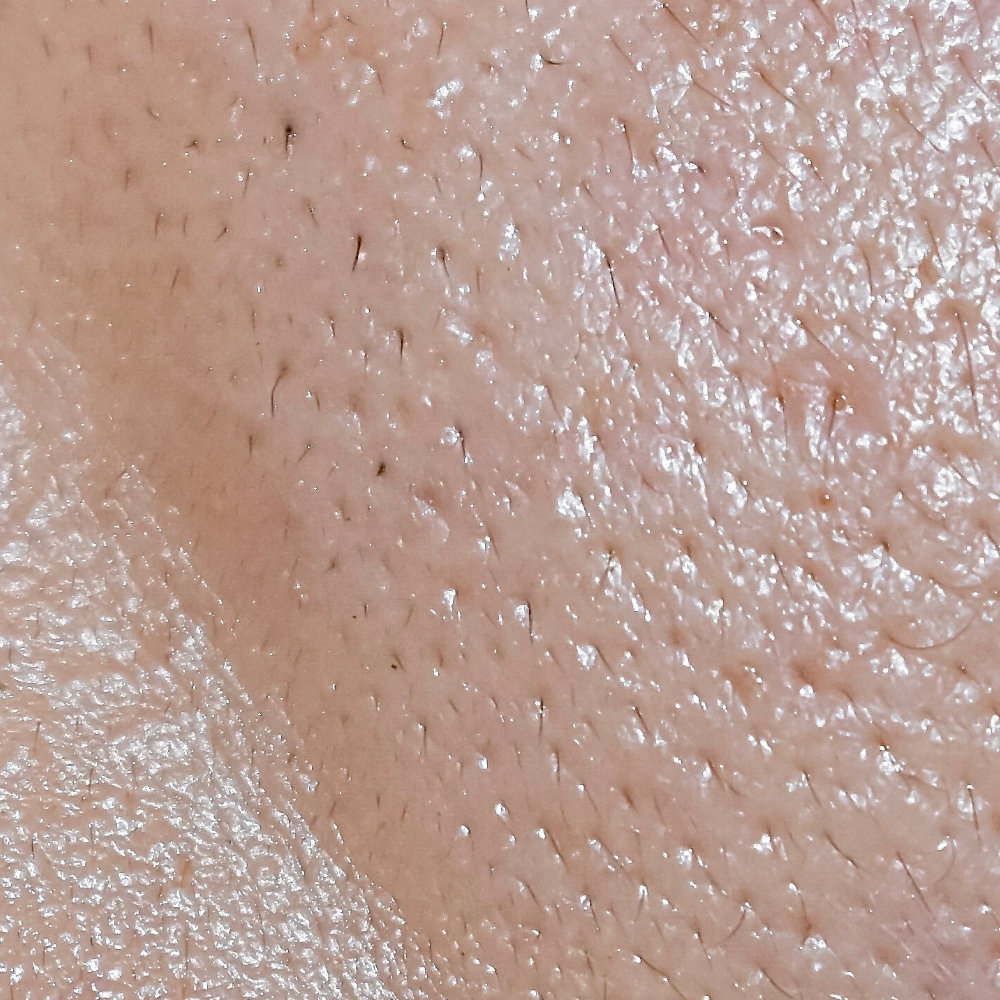 Piele Grasă