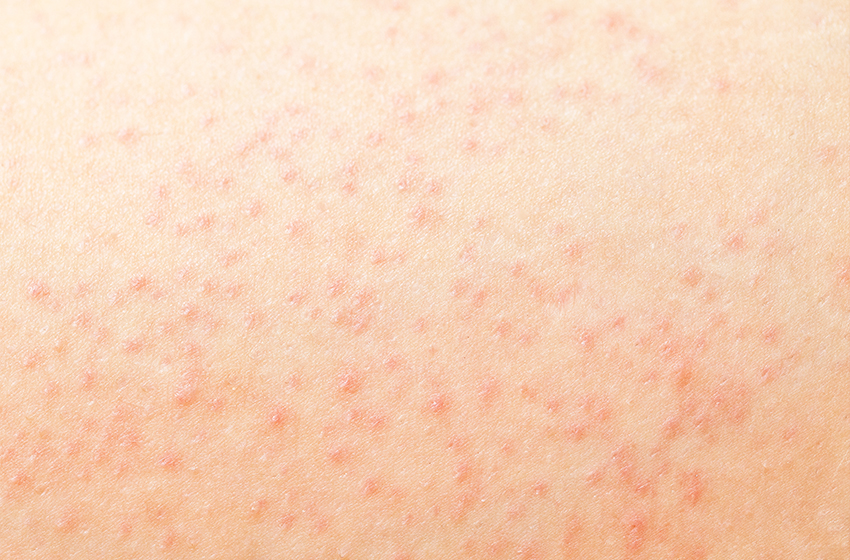 Dermatita de contact