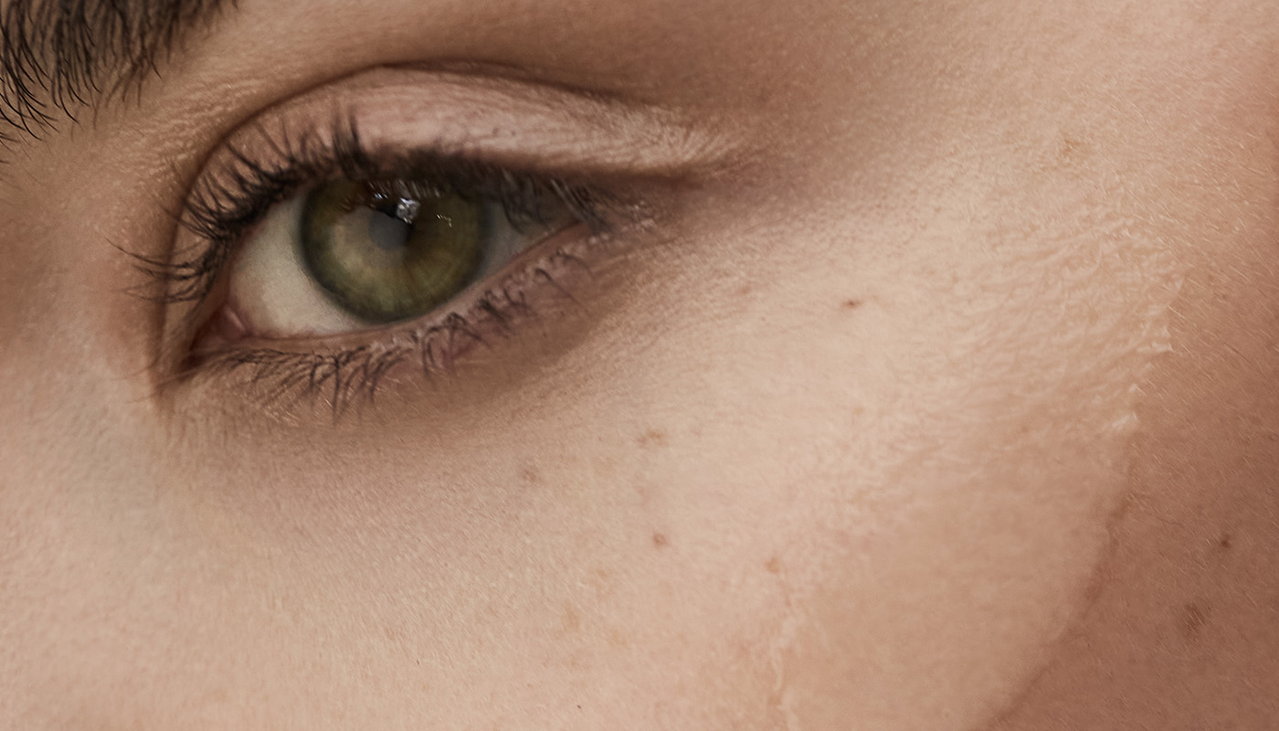 Melasma